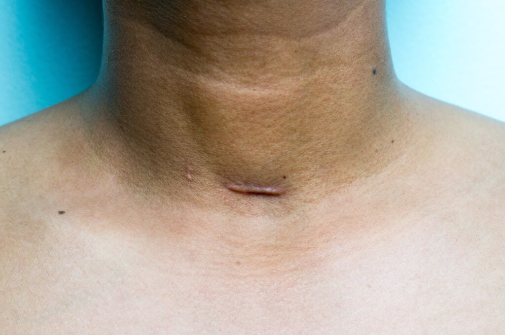 Photo de la cicatrice d'un patient ayant eu une trachéotomie