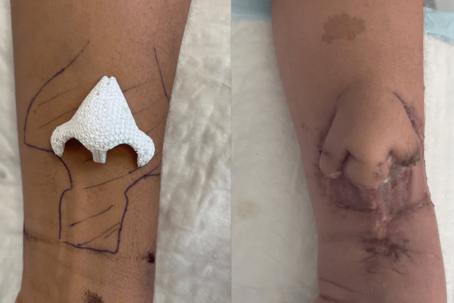 greffe-nez-3D-Carine