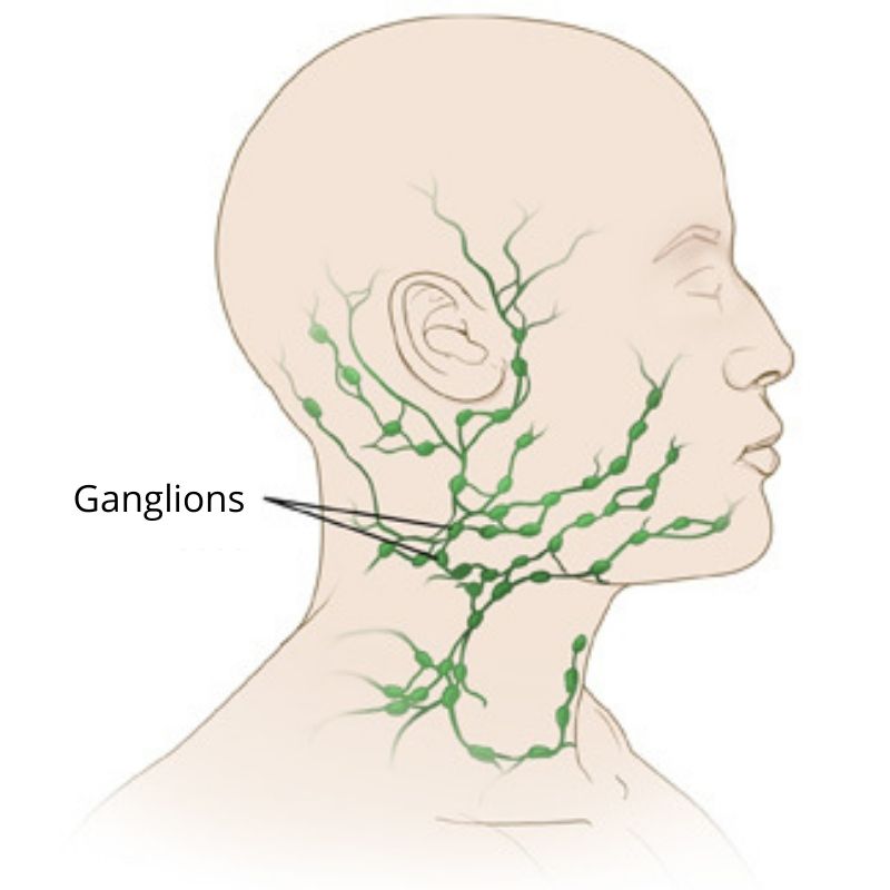 ganglions lymphœdème