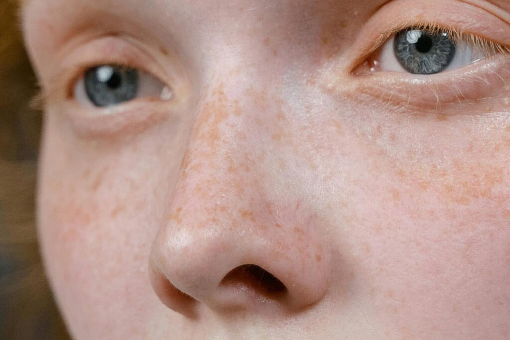 Rhinopoïèse 2 rhinopoïèse