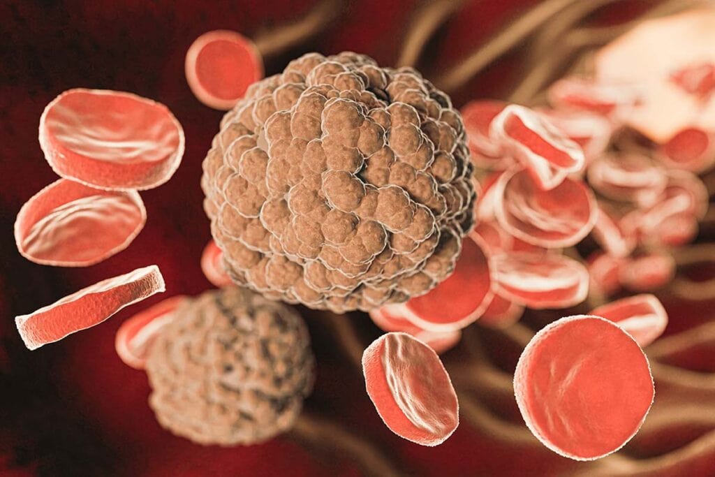 Carcinome adénoïde kystique 1 carcinome adénoïde kystique