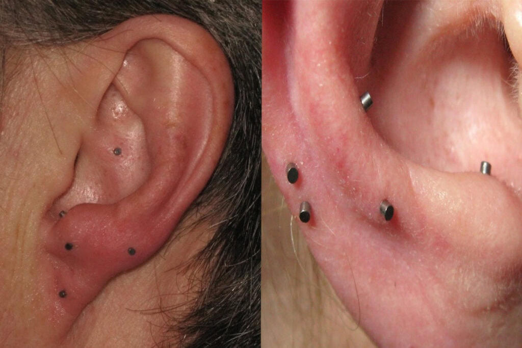 Auriculothérapie 1 auriculotherapie