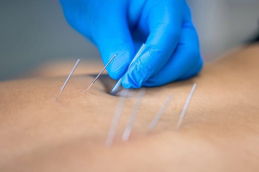 dry-needling