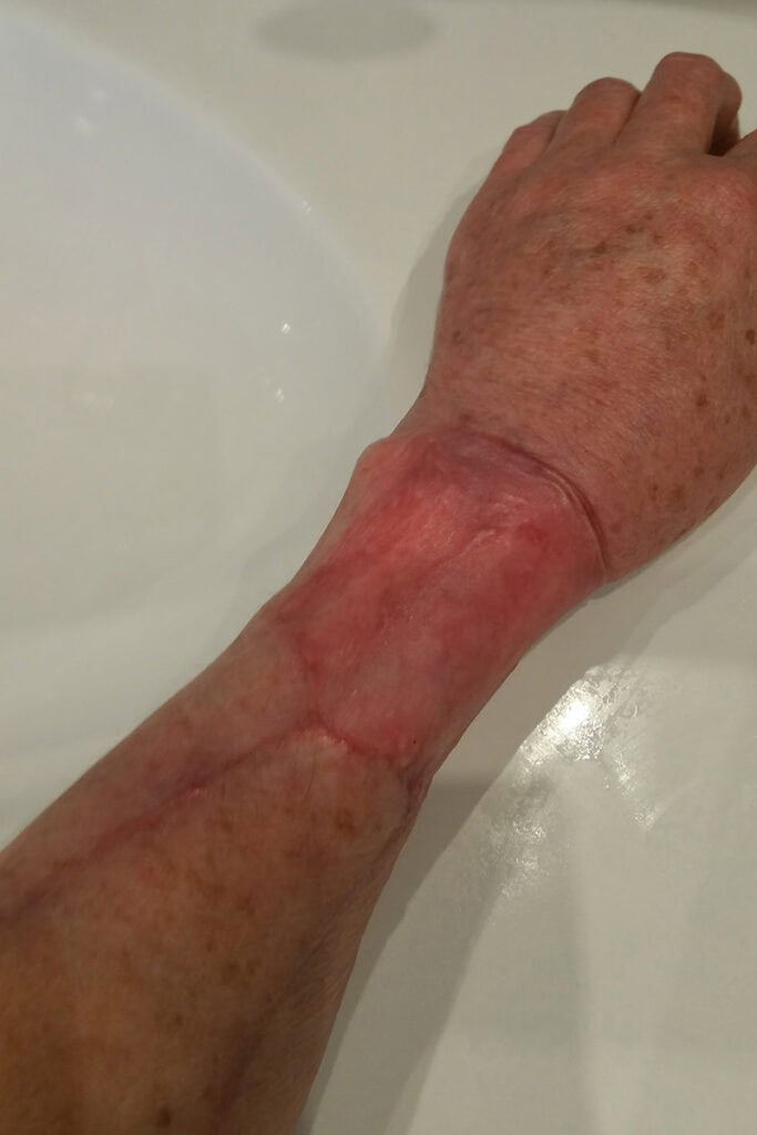 greffe-de-la-cuisse-sur-le-bras-suite-au-lambeau-ante-bracchial