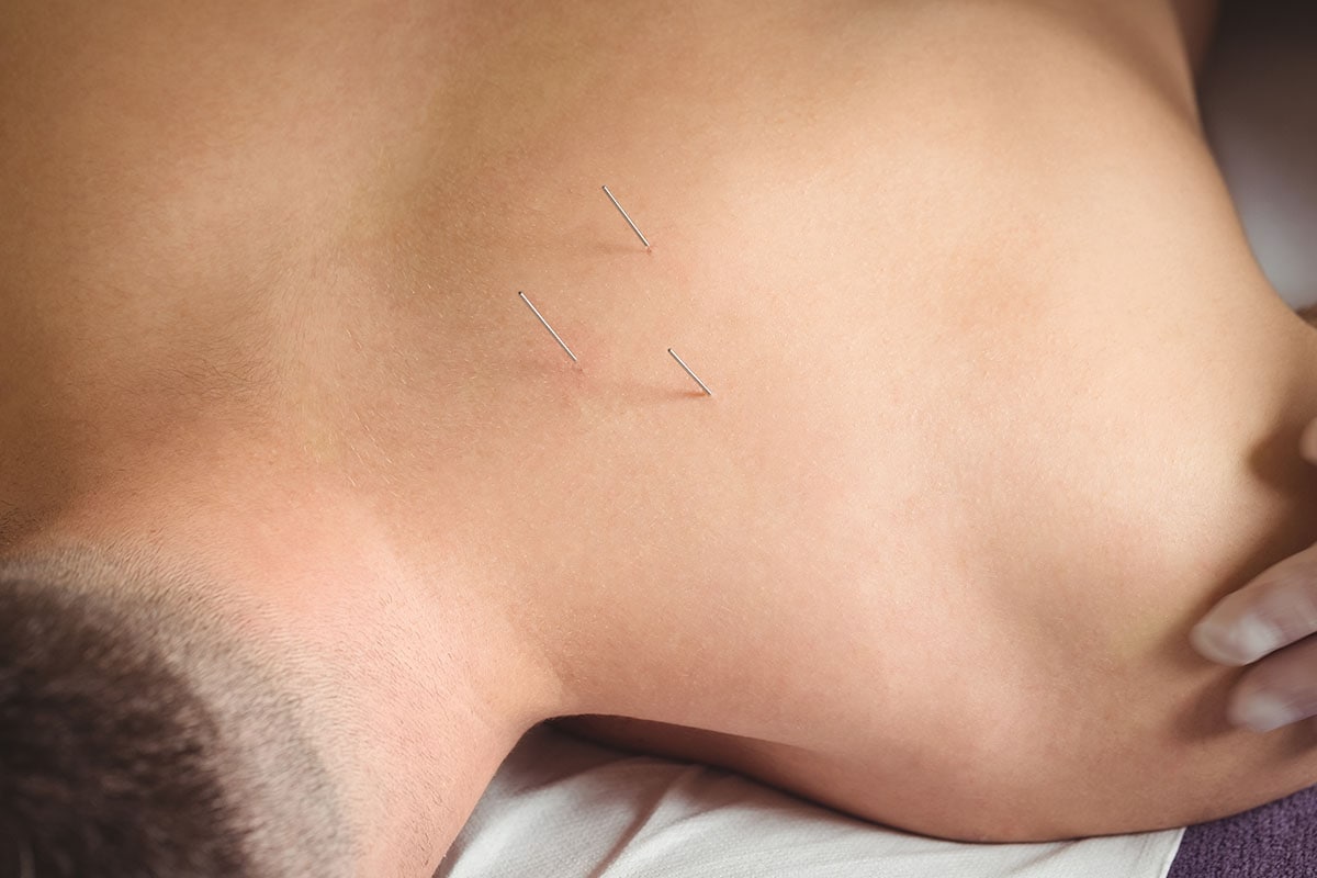 Acupuncture 1 acupuncture